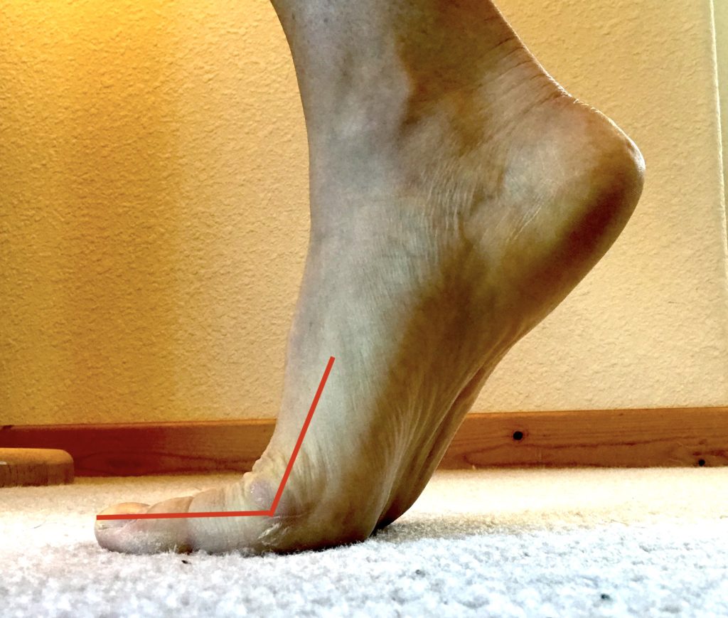 Foot demonstrating passive extension of the big toe. Lines are added to highlight the joint angle. This is almost a healthy foot.